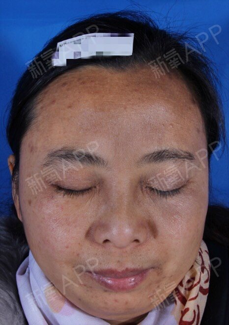 激光返黑后能消吗_激光返黑出现后是什么颜色_激光后的返黑是多久出现