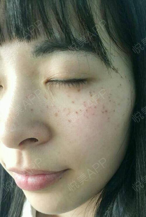 激光返黑出现后是什么颜色_激光后的返黑是多久出现_激光返黑后能消吗