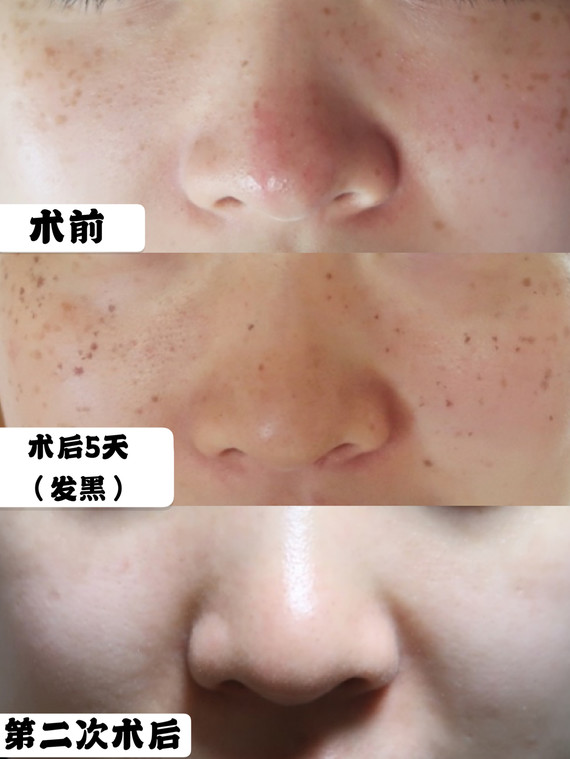 激光返黑后能消吗_激光后的返黑是多久出现_激光返黑出现后是什么颜色