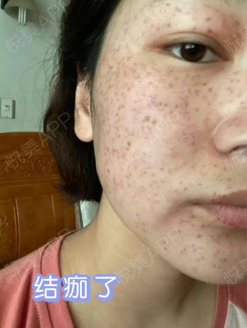 激光后的返黑是多久出现_激光返黑后能消吗_激光返黑出现后是什么颜色