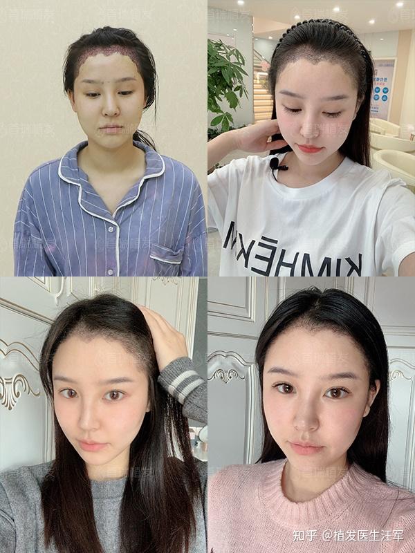 肩膀脱臼多久能恢复好_切除眼袋多久能恢复好_整发际线多久能恢复好