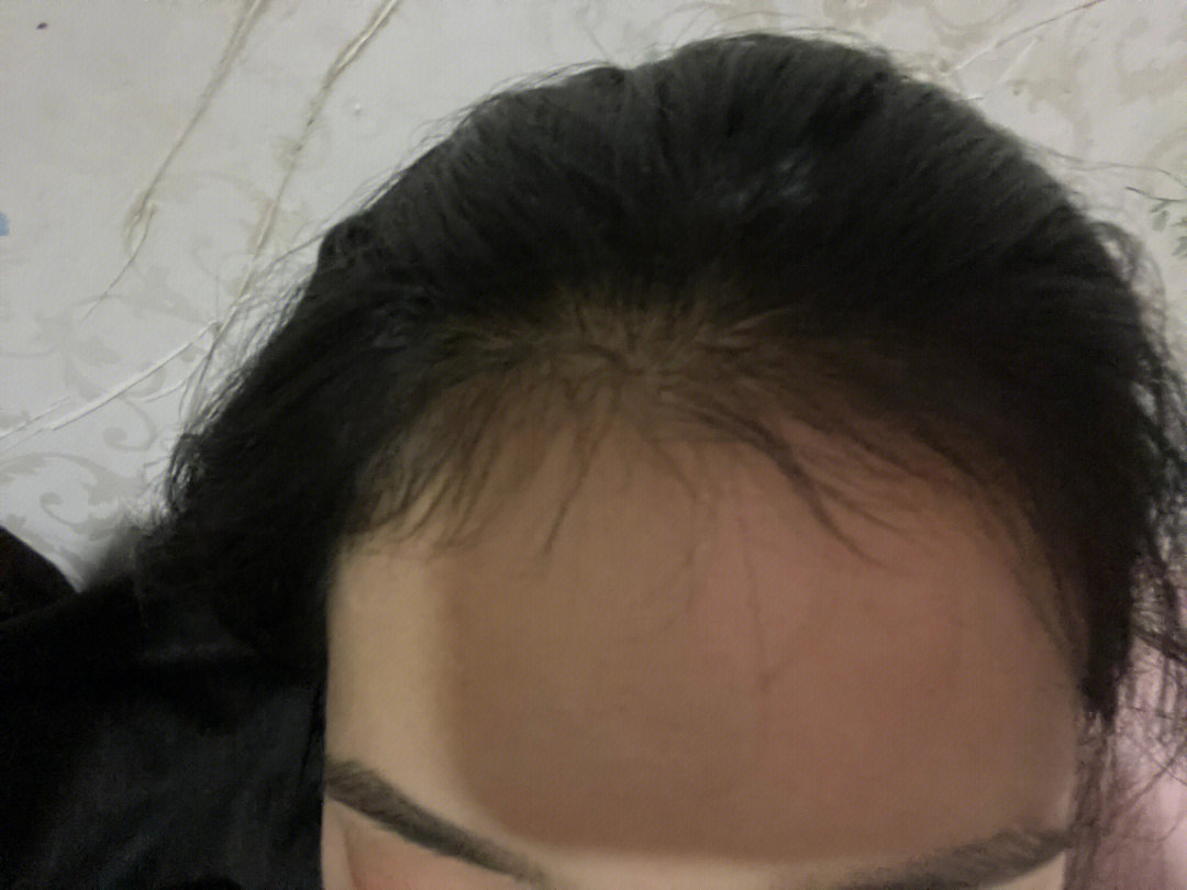 肩膀脱臼多久能恢复好_整发际线多久能恢复好_切除眼袋多久能恢复好