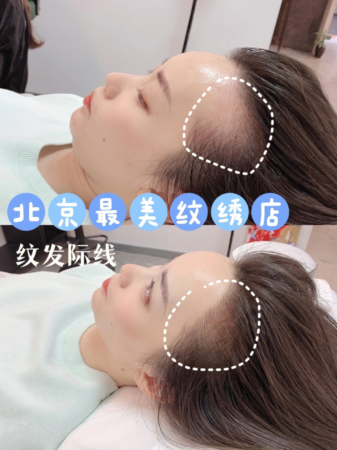 肩膀脱臼多久能恢复好_切除眼袋多久能恢复好_整发际线多久能恢复好