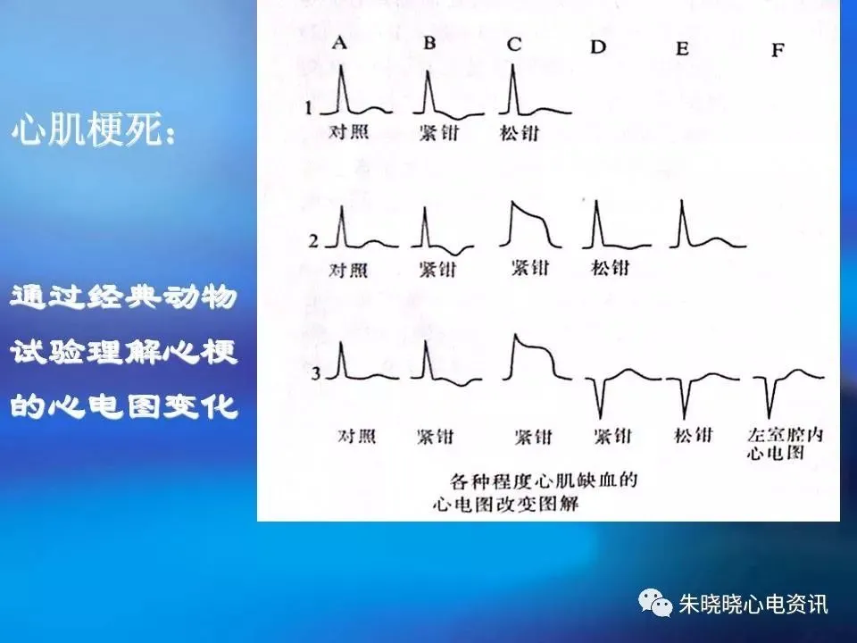 心电图波形改变_心电图q波改变原因_心电图厂波改变