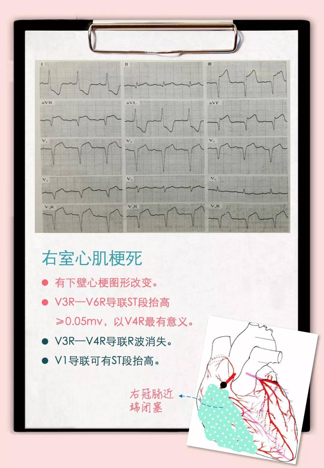 心电图厂波改变_心电图q波改变原因_心电图波形改变