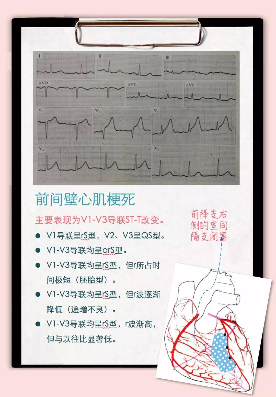心电图q波改变原因_心电图厂波改变_心电图波形改变