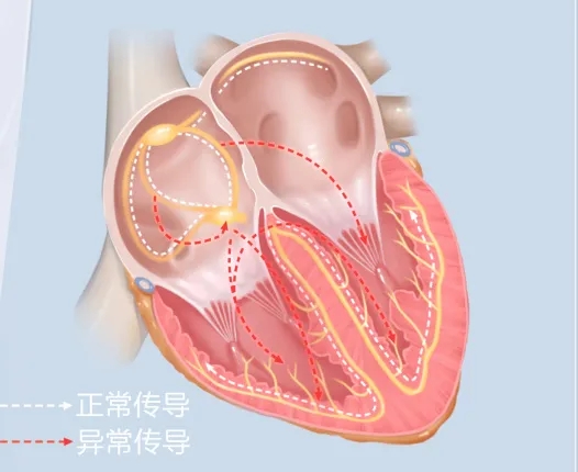 阵发心房扑动_阵发性室上性心动过扑_阵发性心房扑动的治疗